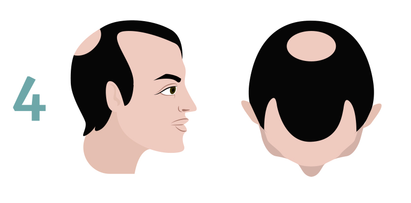 scalp tattoo