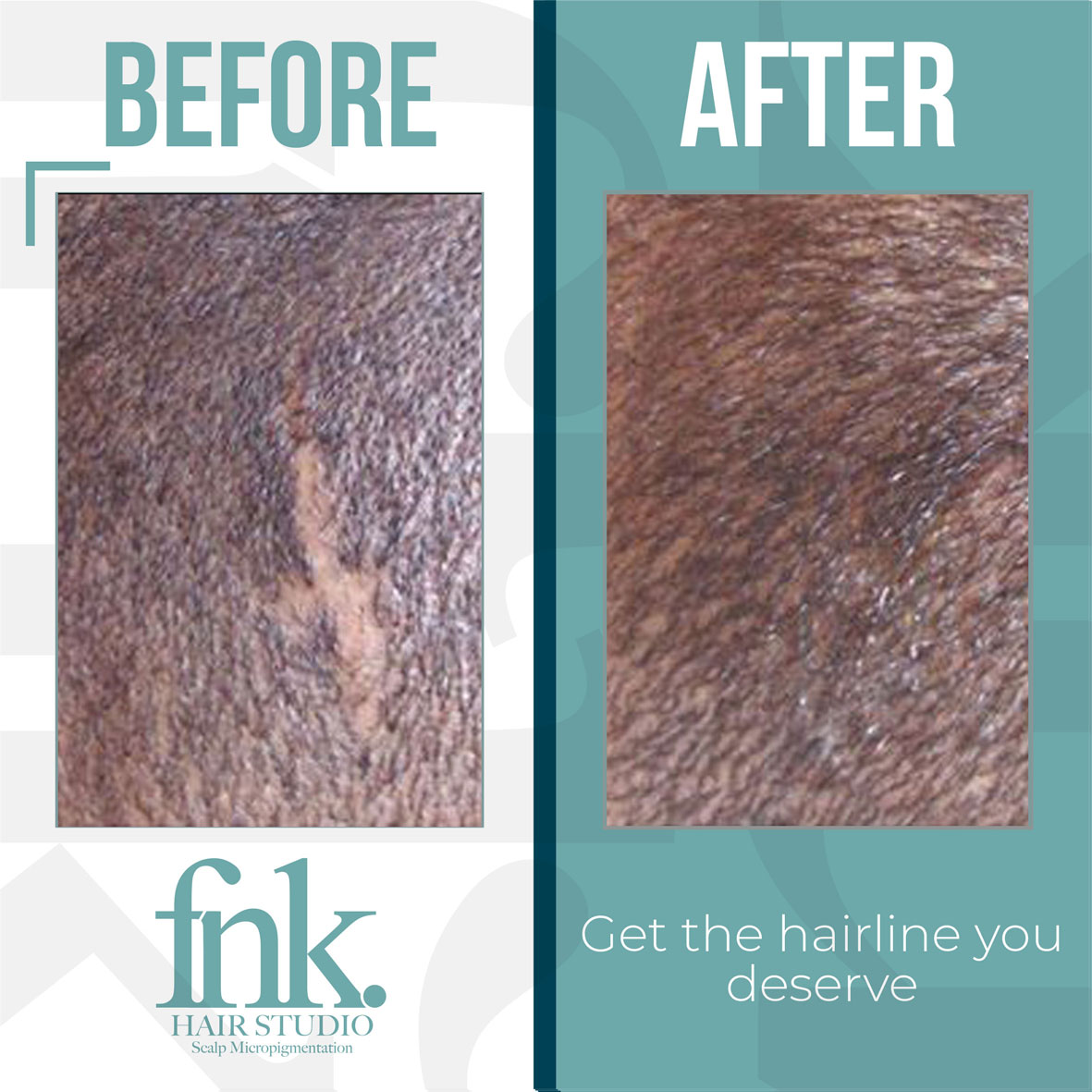 micro scalp micropigmentation